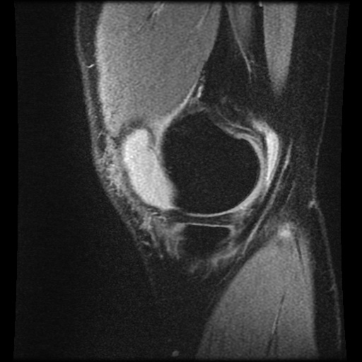 Anterior cruciate ligament tear (Radiopaedia 61500-69462 F 8).jpg