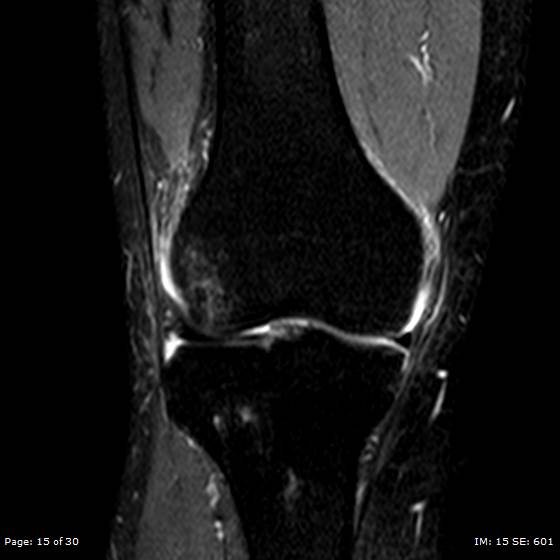 File:Anterior cruciate ligament tear (Radiopaedia 70783-80964 Coronal STIR 15).jpg