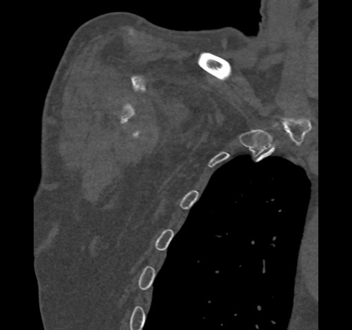 Anterior glenohumeral dislocation with Hill-Sachs lesion (Radiopaedia 62877-71249 Coronal bone window 9).jpg