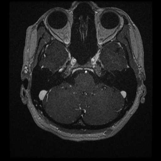 Anterior inferior cerebellar artery vascular loop - type II (Radiopaedia 70991-81209 Axial T1 C+ 57).jpg