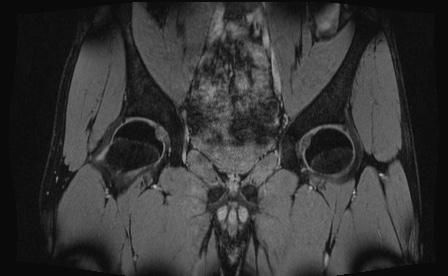 Anterior inferior iliac spine avulsion fracture (Radiopaedia 81312-95000 G 52).jpg