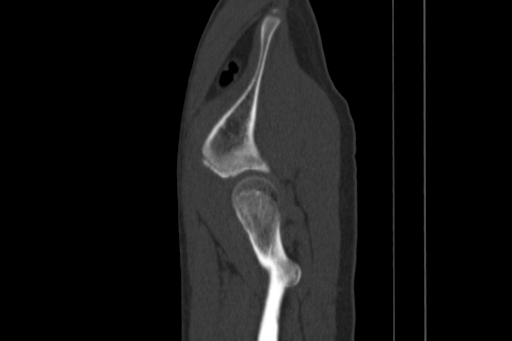 Anterior inferior iliac spine avulsion injury (Radiopaedia 88666-105376 Sagittal bone window 81).jpg
