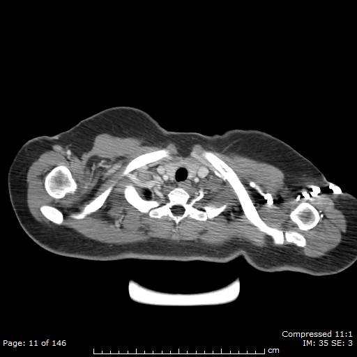 Anterior mediastinal B cell Lymphoma (Radiopaedia 50677-56114 A 6).jpg