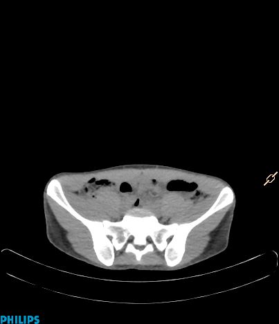 File:Anterior mediastinal seminoma (Radiopaedia 80270-93613 C 43).jpg