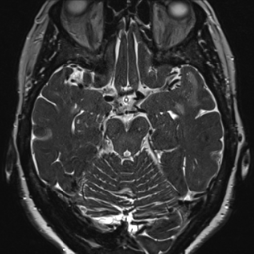 Anterior temporal pole cysts (Radiopaedia 46629-51102 Axial 43).png