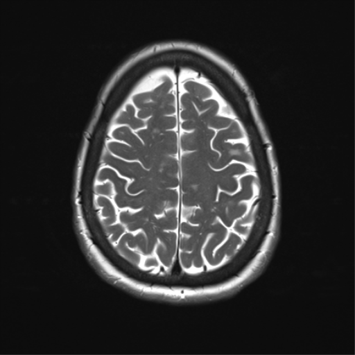File:Anterior temporal pole cysts (Radiopaedia 46629-51102 C 30).png