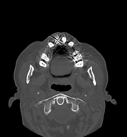File:Anterior temporomandibular joint dislocation (Radiopaedia 59430-66784 Axial non-contrast 28).jpg