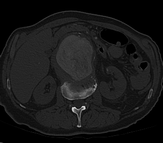 File:Anterior vertebral scalloping (abdominal aortic aneurysm) (Radiopaedia 66744-76067 Axial bone window 15).jpg