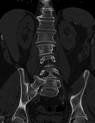 Anterior vertebral scalloping (abdominal aortic aneurysm) (Radiopaedia 66744-76067 Coronal bone window 41).jpg