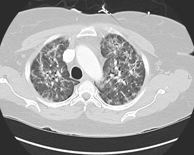 Anti-synthetase syndrome (anti-Jo1) (Radiopaedia 31899-32846 Axial lung window 14).JPG