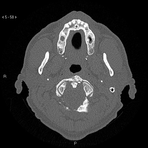 Antrochoanal Polyp (Radiopaedia 70510-80631 Axial bone window 6).jpg