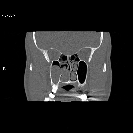 File:Antrochoanal Polyp (Radiopaedia 70510-80631 Coronal bone window 22).jpg