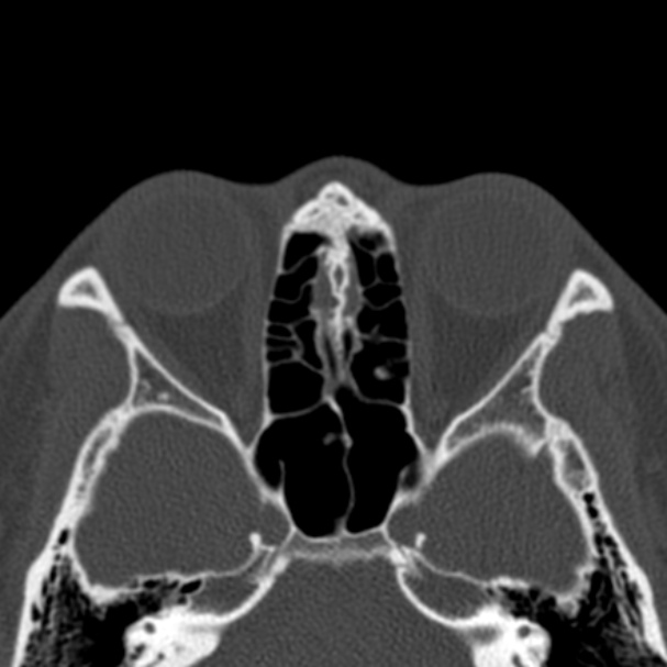 Antrochoanal polyp (Radiopaedia 33984-35202 Axial bone window 52).jpg