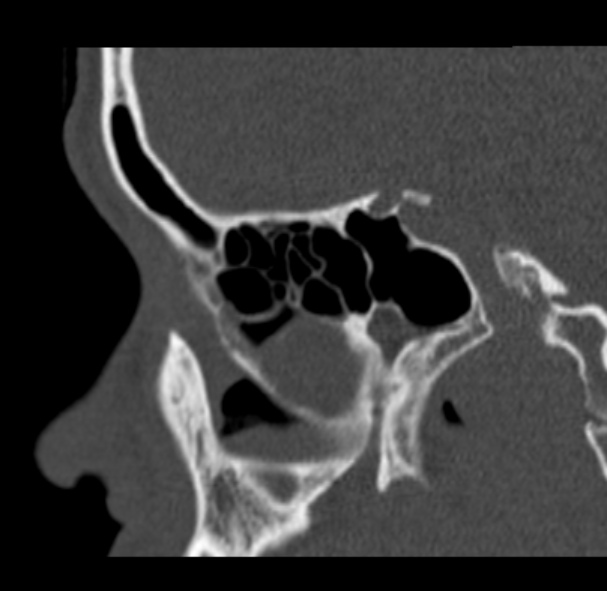 Antrochoanal polyp (Radiopaedia 33984-35202 Sagittal bone window 30).jpg