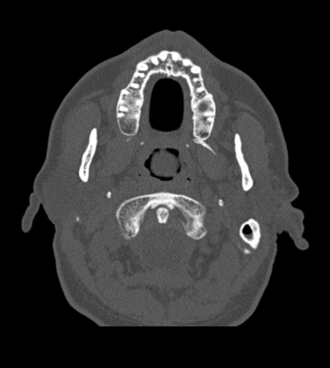 Antrochoanal polyp (Radiopaedia 79011-92169 Axial bone window 4).jpg