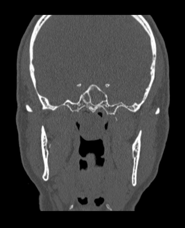 Antrochoanal polyp (Radiopaedia 79011-92169 Coronal bone window 16).jpg