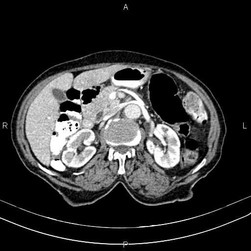 File:Aortic aneurysm and Lemmel syndrome (Radiopaedia 86499-102554 A 33).jpg