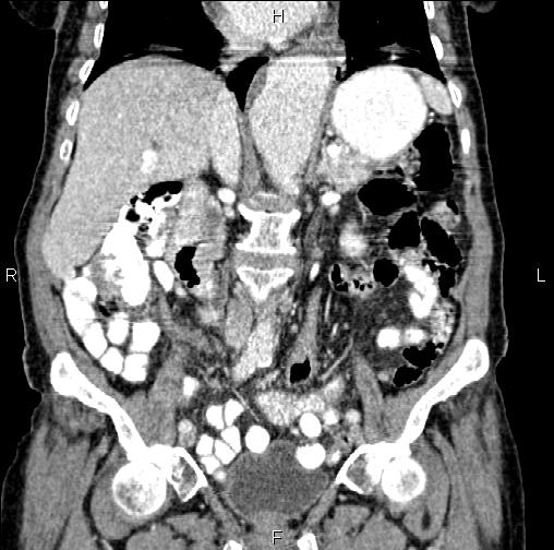 Aortic aneurysm and Lemmel syndrome (Radiopaedia 86499-102554 C 29).jpg