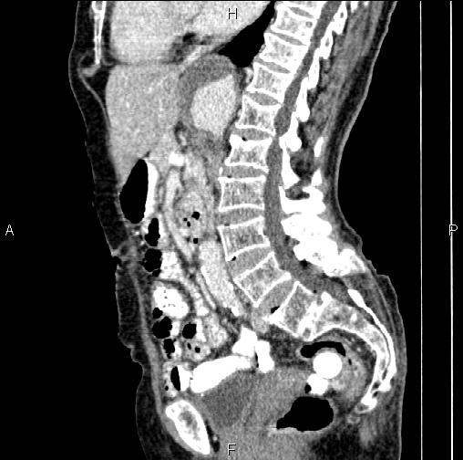 Aortic aneurysm and Lemmel syndrome (Radiopaedia 86499-102554 D 44).jpg