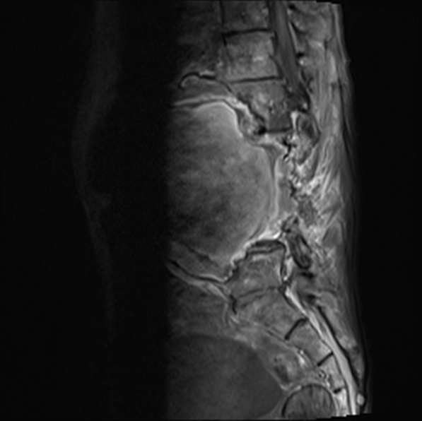 File:Aortic aneurysm with spinal destruction (Radiopaedia 42301-45409 Sagittal T1 fat sat 23).jpg
