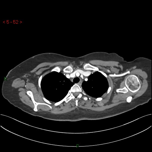Aortic arch origin of left vertebral artery (Radiopaedia 51520-57286 A 51).jpg