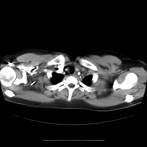 File:Aortic arch stent (Radiopaedia 30030-30595 D 1).jpg