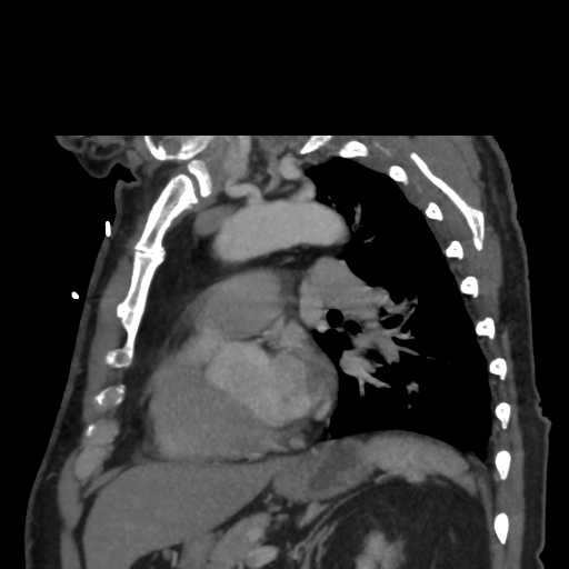 File:Aortic dissection- Stanford A (Radiopaedia 37759-39664 D 22).png