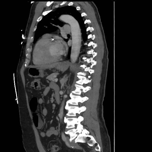 File:Aortic dissection- Stanford A (Radiopaedia 37759-39664 Sagittal C+ delayed 24).png