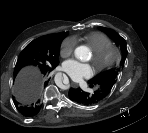 Aortic dissection (CTPA) (Radiopaedia 75506-86750 A 55).jpg