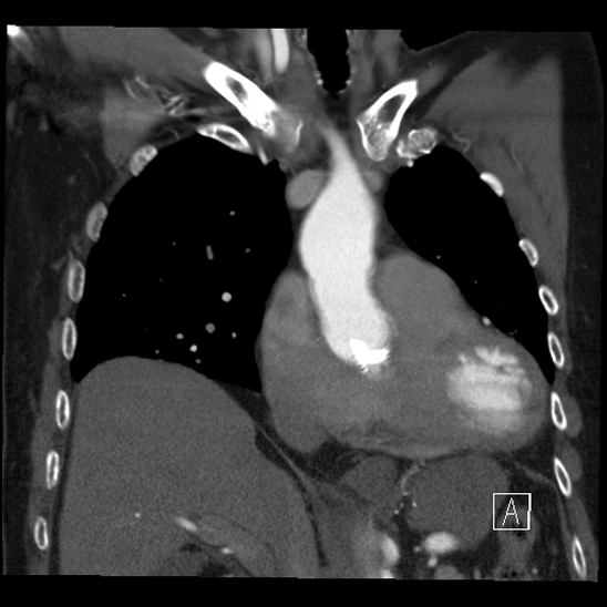 Aortic dissection (CTPA) (Radiopaedia 75506-86750 B 25).jpg