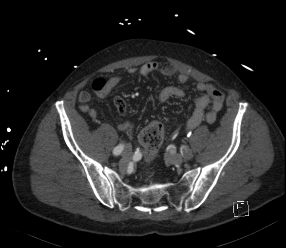 Aortic dissection (CTPA) (Radiopaedia 75506-86750 E 117).jpg