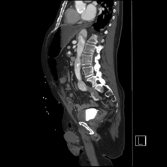 Aortic dissection (CTPA) (Radiopaedia 75506-86750 G 63).jpg
