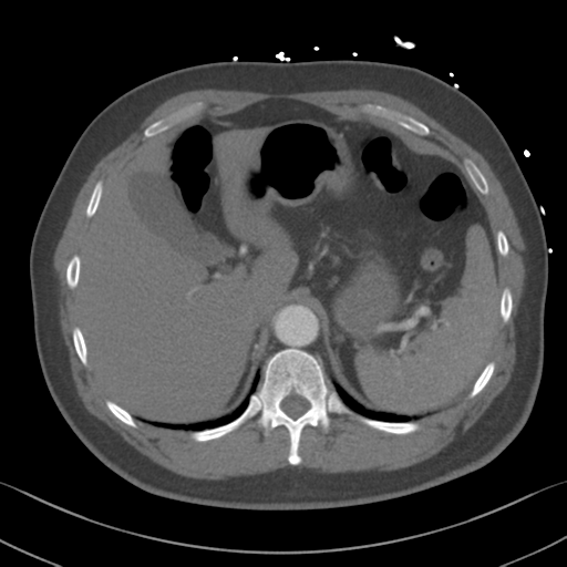 File:Aortic dissection (Radiopaedia 50763-56234 A 74).png