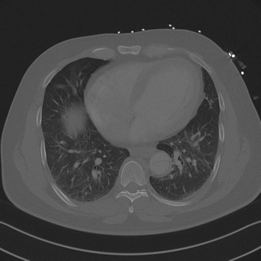 Aortic dissection (Radiopaedia 50763-56234 Axial bone window 69).png