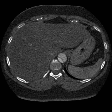 Aortic dissection (Radiopaedia 57969-64959 A 285).jpg