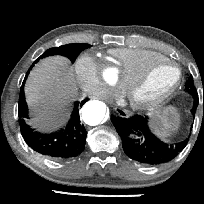 Aortic dissection - DeBakey Type I-Stanford A (Radiopaedia 79863-93115 A 30).jpg