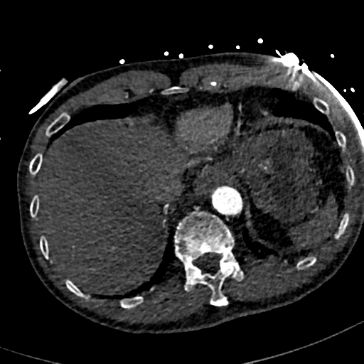File:Aortic dissection - DeBakey type II (Radiopaedia 64302-73082 A 78).png