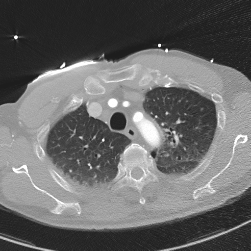 Aortic dissection - DeBakey type II (Radiopaedia 64302-73082 Axial lung window 14).png