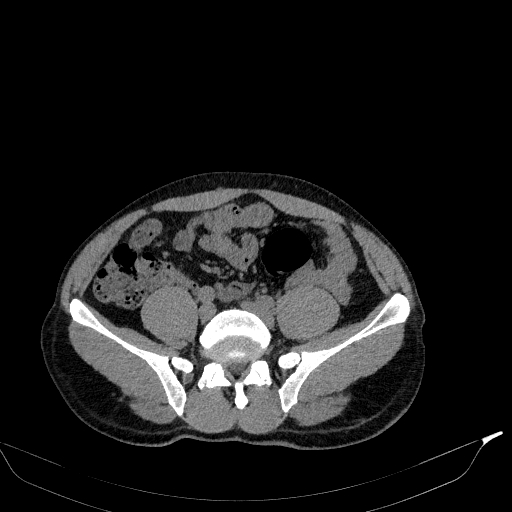 File:Aortic dissection - Stanford type A (Radiopaedia 83418-98500 Axial non-contrast 71).jpg