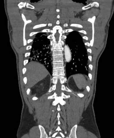 File:Aortic dissection - Stanford type B (Radiopaedia 73648-84437 B 97).jpg