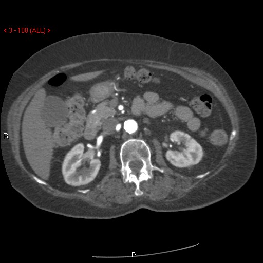 Aortic intramural hematoma (Radiopaedia 27746-28001 A 108).jpg
