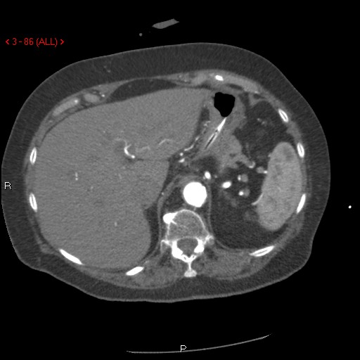 Aortic intramural hematoma (Radiopaedia 27746-28001 A 86).jpg