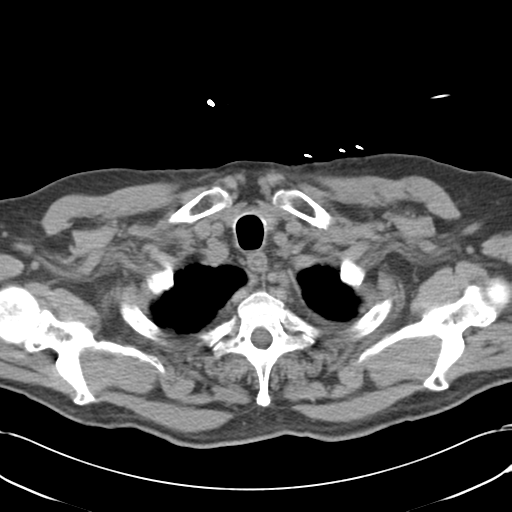 Aortic intramural hematoma (Radiopaedia 34260-35540 Axial non-contrast 7).png