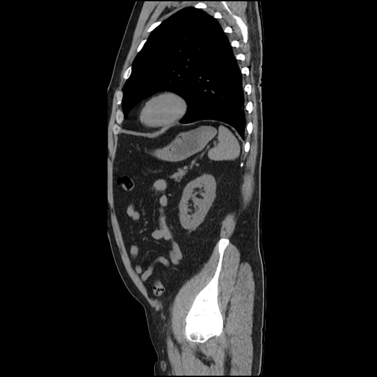 File:Aortic intramural hematoma (type B) (Radiopaedia 79323-92387 G 42).jpg