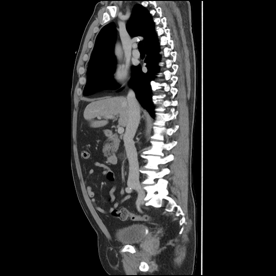 Aortic intramural hematoma (type B) (Radiopaedia 79323-92387 Sagittal C+ delayed 20).jpg