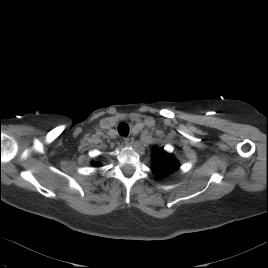 Aortic intramural hematoma with dissection and intramural blood pool (Radiopaedia 77373-89491 Axial non-contrast 14).jpg