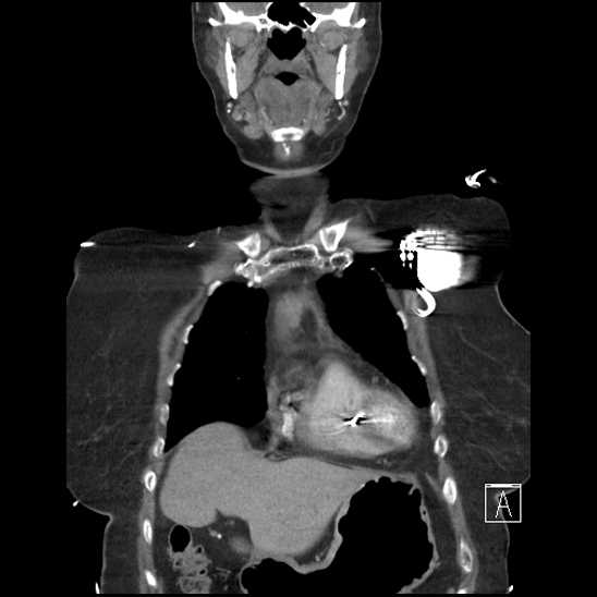 Aortic intramural hematoma with dissection and intramural blood pool (Radiopaedia 77373-89491 C 11).jpg