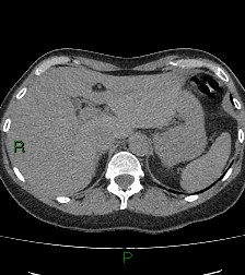 File:Aortic valve endocarditis (Radiopaedia 87209-103485 Axial non-contrast 92).jpg