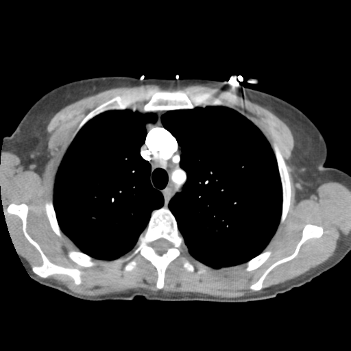 File:Aortic valve non-coronary cusp thrombus (Radiopaedia 55661-62189 B 13).png