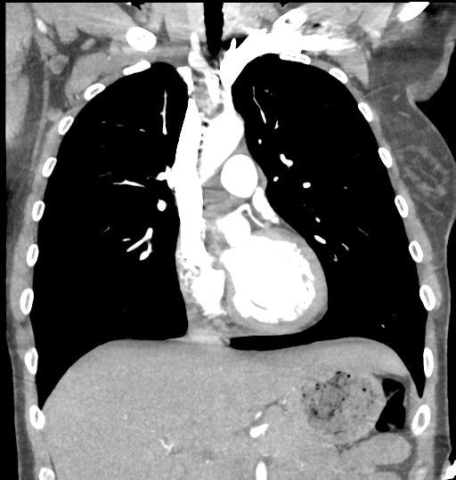 File:Aortic valve non-coronary cusp thrombus (Radiopaedia 55661-62189 C 34).png